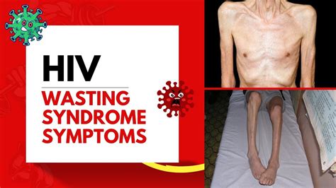 HIV wasting syndrome - HIV - Veterans Affairs