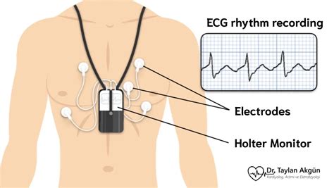 Holter monitor - Mayo Clinic - coolestguyplanet.net