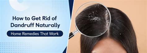 Home Remedies to Help Reduce Dandruff Naturally - PharmEasy - balustradellc
