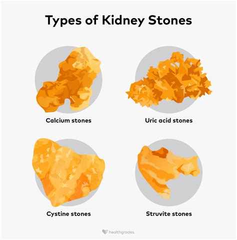 How being overweight contributes to kidney stones and what to do … - balustradellc