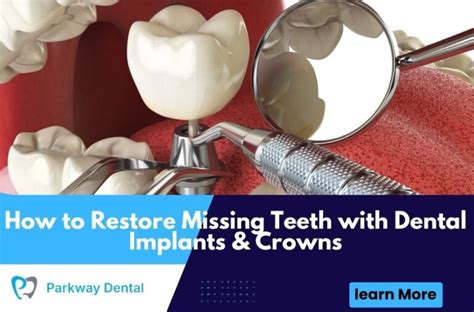 How Dental Implants Restore Missing Teeth - balustradellc