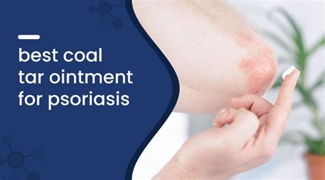 How Does Coal Tar Help Psoriasis: Uses and Risks - balustradellc