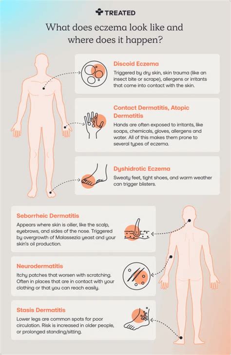 How Eczema Is Treated - Verywell Health - balustradellc