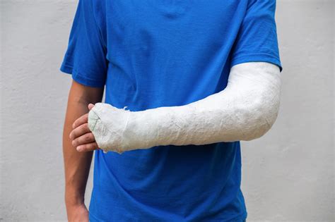 How Plaster Casts are Used to Treat Fractures - muktibox.com