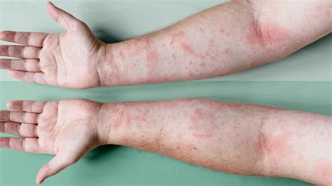 How Severe Eczema Is Treated - Verywell Health - balustradellc