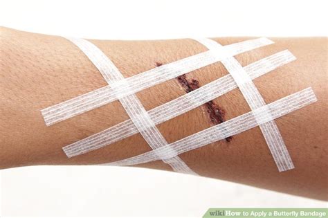 How to Apply a Butterfly Bandage: 11 Steps (with Pictures) - balustradellc