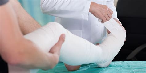 How To Apply a Cast - Injuries; Poisoning - MSD Manuals - muktibox.com