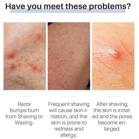 How to Avoid Pimples After Shaving Pubic Hair: Key … - balustradellc
