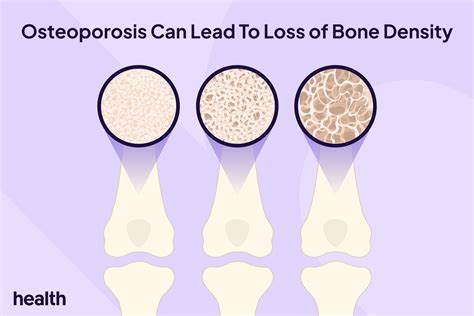 How To Build Bone Density: 7 Tips for Stronger Bones - balustradellc
