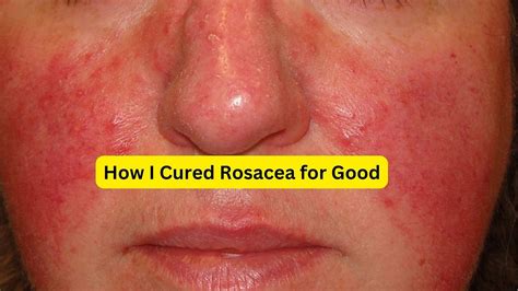 How to Clear Up Rosacea: Effective Treatments and … - balustradellc