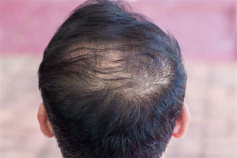 How to Control Hair Fall in Men: Step-by-Step Guide - balustradellc