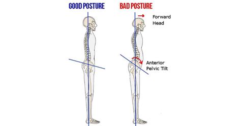How to Correct Anterior Pelvic Tilt & Lumbar Lordosis - balustradellc