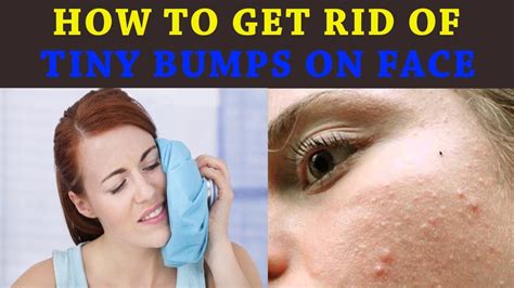 HOW TO GET RID OF ACNE, PIMPLES, TINY BUMPS ON …