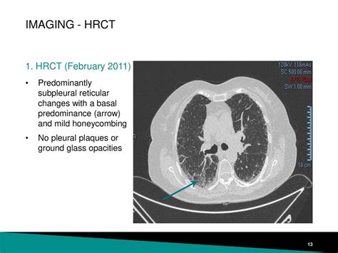 HRCT - Basic Interpretation - The Radiology Assistant - wintechmobiles.com