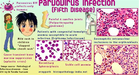 HUMAN PARVOVIRUS B19 INFECTION: ITS ROLE IN ACUTE ARTHROPATHIES