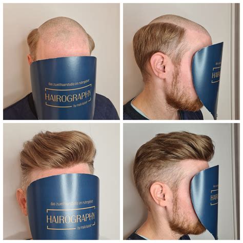 Haarsysteme für Männer: Die moderne Lösung für Haarausfall