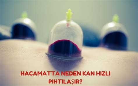 Hacamat yaparken kan neden pıhtılaşır? kan, damar duvarından salgılanan antikoagülan (pıhtılaşma engelleyici) maddeler kesintiye uğradığı zaman pıhtılaşmaya başlar.