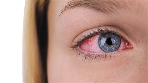Had pink eye recently? There’s a chance it could have been from new COVID-19 strain