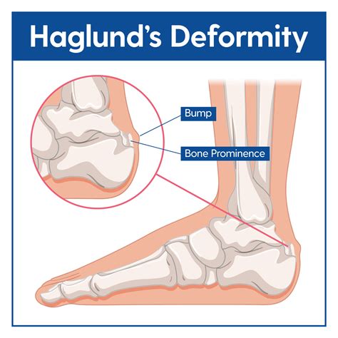 The Icd 10 code for Haglund's Deformity is M77.31. This code is used to classify and document the condition for medical billing and coding purposes. It is important for …