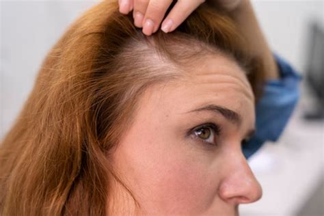 Hair Loss After Coloring
