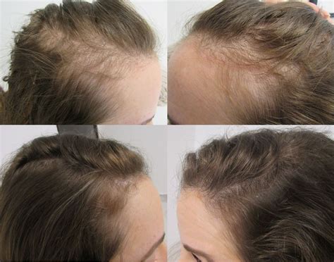 Hair Regrowth, Female Hair Loss, Hair Therapy Near Me, Thicker …