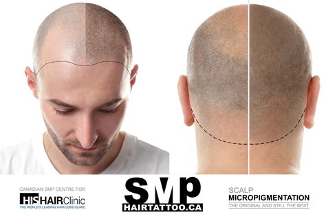 Hair Tattoo: What Is Scalp Micropigmentation?