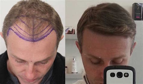 Hair Transplant Cost Dr. Rahal