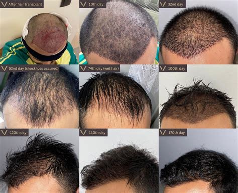 Hair Transplant Growth Timeline Dr. Cortez - Hair Center Mexico