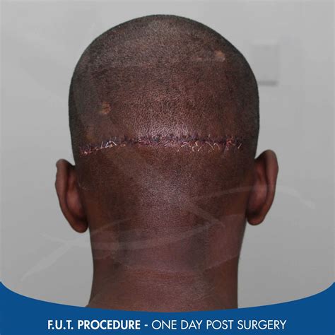 Hair Transplant Scar Images Test