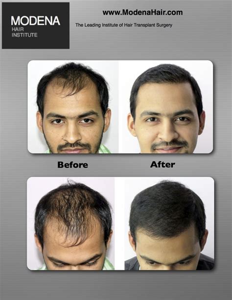 Hair Transplant Surgery in Las Vegas Hair Loss Treatment