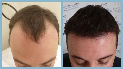 Hair Transplant in Turkey: Low Costs and Package Deals