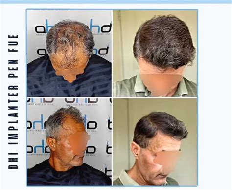 Hair Wash After Hair Transplant Dr. Hakan Doganay