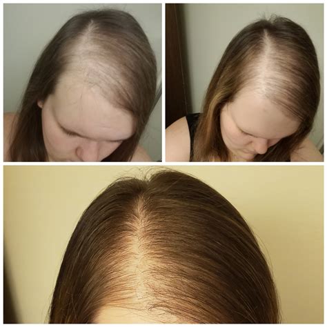 Hair for female pattern baldness - Pinterest