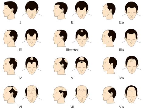 Hair loss a sufferers guide female hair loss male pattern. - Catalogue des travaux de jean dubuffet.