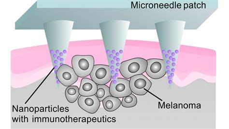Hair loss cure news.  The microneedle patch delivers immune-regulating mo...