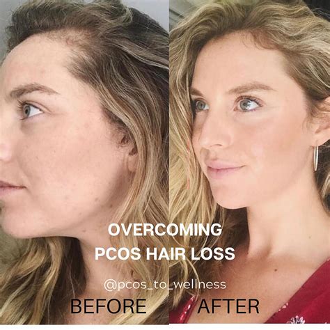 Hair loss treatment : r/PCOS - Reddit