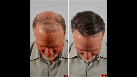 Hair replacement service. With a passion for helping those in West Palm Beach who struggle with thinning hair and hair loss, Hair Professionals offers state of the art, custom solutions for resolving hair loss. Specializing in solutions for thinning hair and hair replacement for more than 20 years, our cutting edge techniques and procedures are fully personalized. 