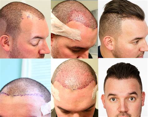 Hair restoration network. HDC Hair Clinic is about to present a series of Giga session results, starting today. This is a 31 years old NW Class 5 patient who wanted to cover an area of his baldness so that the result would look natural, have a good density, and not look half finished. This could only be achieved by taking... 