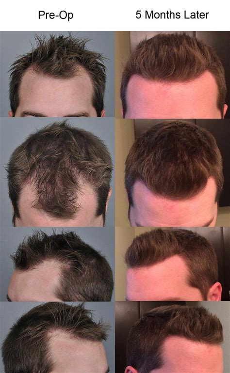 Hair surgery reddit. Is a pink scalp normal after hair transplant surgery? Yes. Your scalp is expected to be quite red or pink following your hair transplant procedure. 