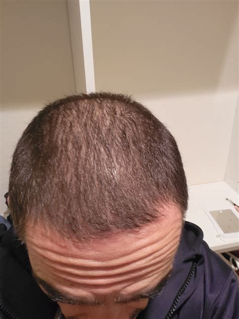 Hair thinning : r/malehairadvice - Reddit