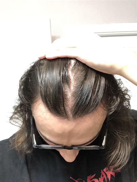 Hair thinning reddit. Medical Conditions: Thyroid disorders, autoimmune diseases like alopecia areata, and scalp infections can cause hair loss. Medications and Treatments: Certain medications and treatments, including chemotherapy, can lead to temporary or permanent hair loss. Stress: Both physical and emotional stress can cause hair loss by triggering telogen ... 