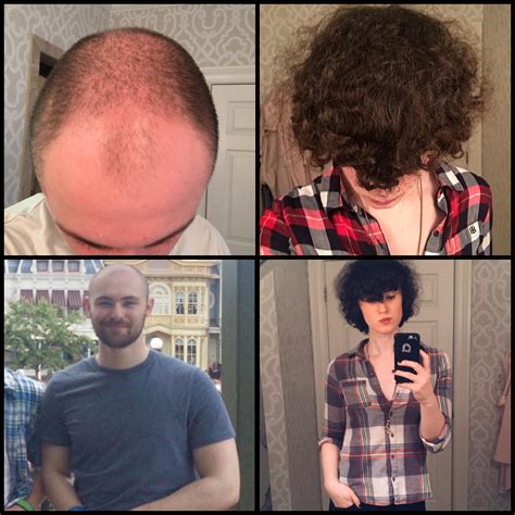 Hair transplant reddit. Is hair transplant worth it? Hi everyone! I am a 29-yo with a receding hairline (first photo). My hairline has never been great, but it has gotten worse in recent years. I've been taking fin for about two years now and the recession has slowed but continues to progress. 