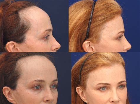 Hairline Lowering Forehead Reduction Procedure NY