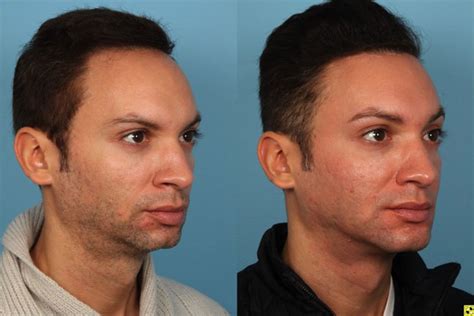 Hairline Lowering in Chicago, IL - Dr. Sidle