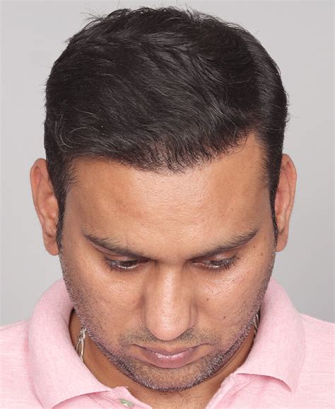 Hairline Reconstruction - QHT Clinic - Hair Transplant Service India