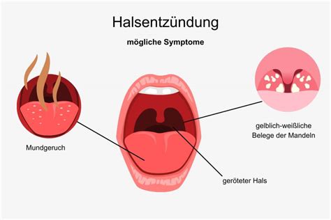 Halsschmerzen, Fieber & Gliederschmerzen: Med. Fakten