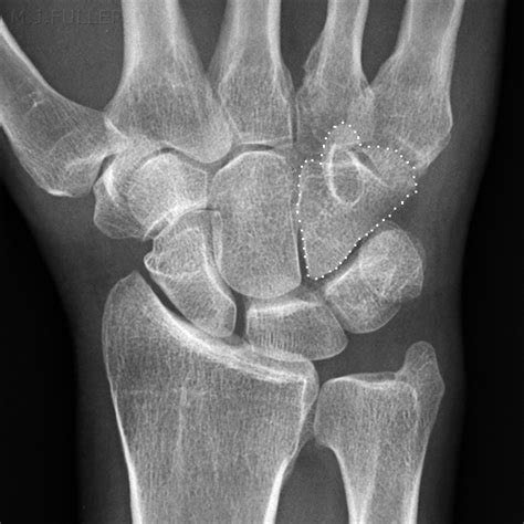 Hamate Fracture - an overview ScienceDirect Topics