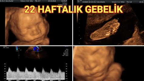 Hamilelikte 17 hafta ultrason görüntüleri