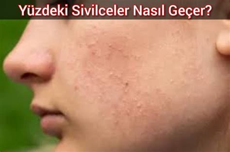 Hamilelikte Yüzdeki Sivilceler Nasıl Geçer Türk Dili Ve Edebiyatı. 