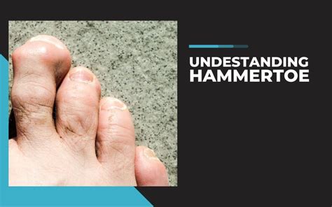 Hammertoe Symptoms & Causes FootCareMD. 
